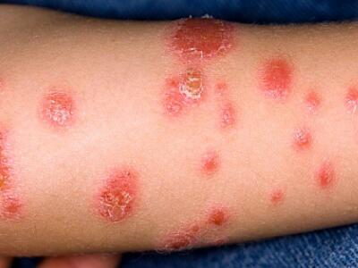 银屑病患者被开水烫了咋办