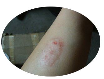 广州治疗牛皮癣医院哪家好