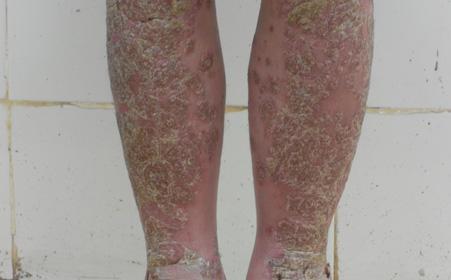 东莞人脚上出现了牛皮癣吃药能不能治好