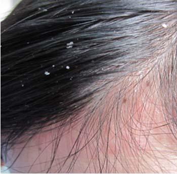 头癣是牛皮癣吗