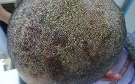 广州头部牛皮癣患者的六大问都有哪些
