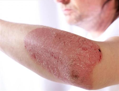 银屑病的皮肤护理