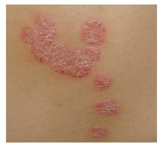 牛皮癣扩散还能治吗