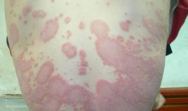 快来看看广州银屑病医院为患者提供的护肤小妙招 快来看看广州银屑病医院为患者提供的护肤小妙招