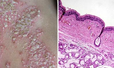 牛皮癣饮食忌嘴