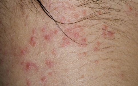 银霄病患者要注意什么