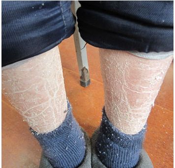 广州哪家医院治疗牛皮癣好