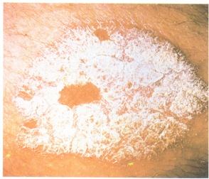 得了牛皮癣可以用偏方吗