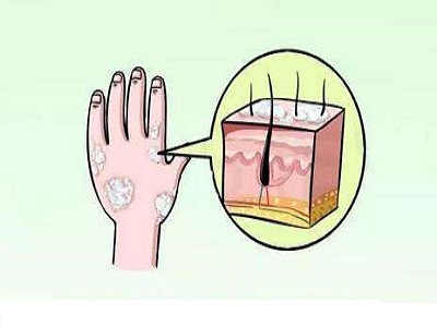 当这些症状与牛皮癣症状放在一起你还能分得清吗 当这些症状与牛皮癣症状放在一起你还能分得清吗