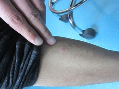 牛皮廨如何止痒