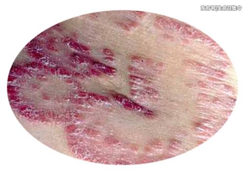 广州地区银屑病的类型有哪些?患者的饮食需要注意什么 广州地区银屑病的类型有哪些?患者的饮食需要注意什么