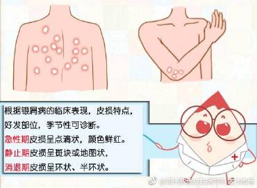 一份抗冬季牛皮癣复发攻略记得收藏 一份抗冬季牛皮癣复发攻略记得收藏