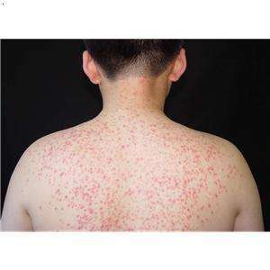 牛皮癣对青少年的影响