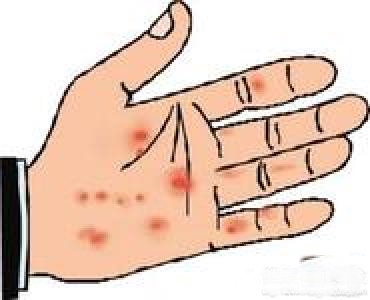 牛皮癣发病额因素有哪些