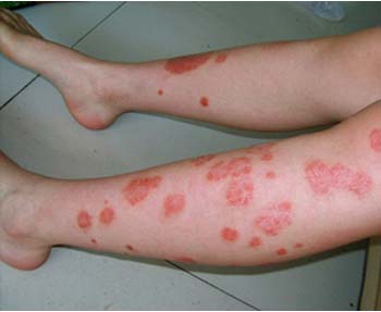 离牛皮癣康复有多远