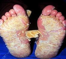 广东人患上牛皮癣后应该做什么 广东人患上牛皮癣后应该做什么