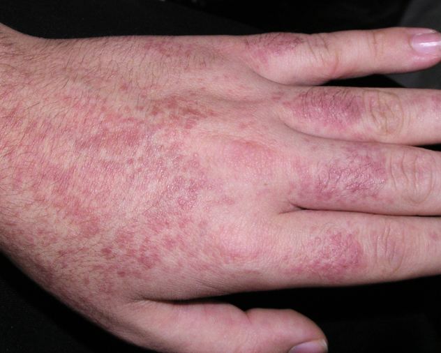 老年银屑病患者的饮食