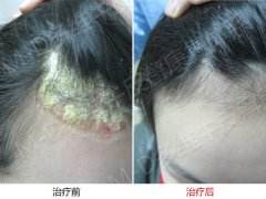 女性牛皮癣患者必须掌握的护理方法