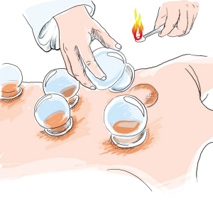 牛皮癣患者们可以拔罐吗