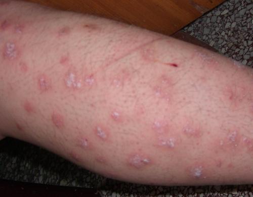 及时添加衣物小心患上牛皮癣