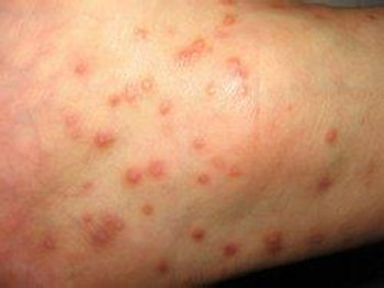 牛皮癣为何喜欢孩子