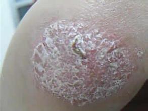 防止银屑病复发吃什么