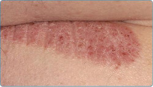 如何预防牛皮癣发作