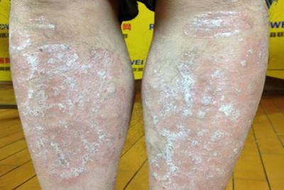 银屑病患者飘落雪花怎么回事