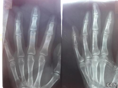 关节型牛皮癣病人如何检查