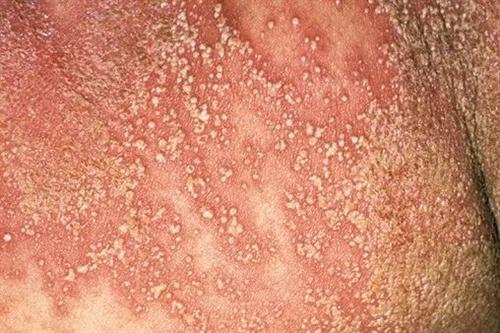 科学治疗牛皮癣