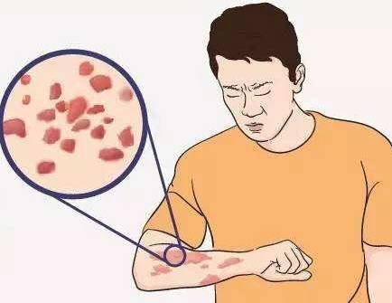 牛皮癣患者应该如何选择医院