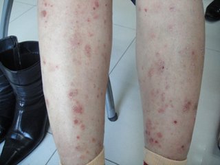 牛皮癣爬满全身的原因