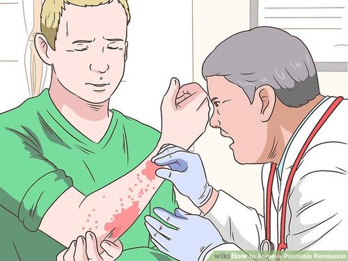 牛皮癣冬日护理措施