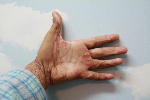 牛皮癣康复征兆什么样