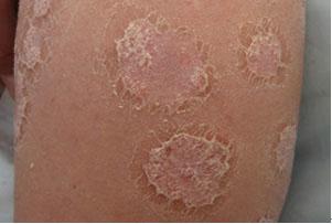 节段性银屑病的病因是什么 节段性银屑病的病因是什么