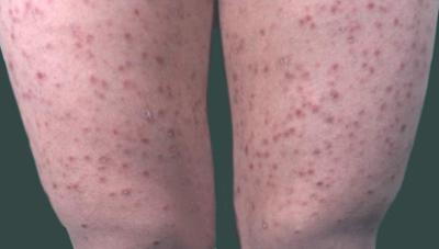 夏天解暑吃什么