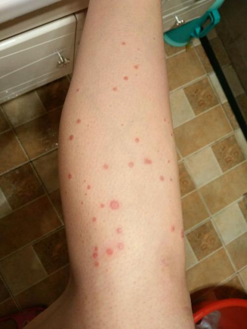 想要和牛皮癣说拜拜应该怎么做