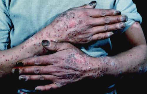 银霄病低龄化的原因